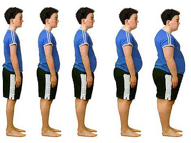 Obesidad celiaquía
